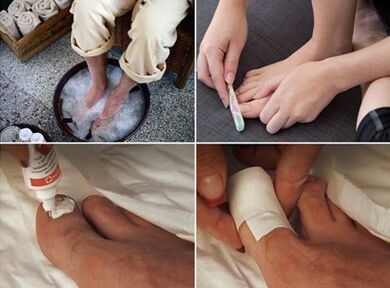 Распаривание ног и нанесение на пораженные грибком ногти крема с мочевиной