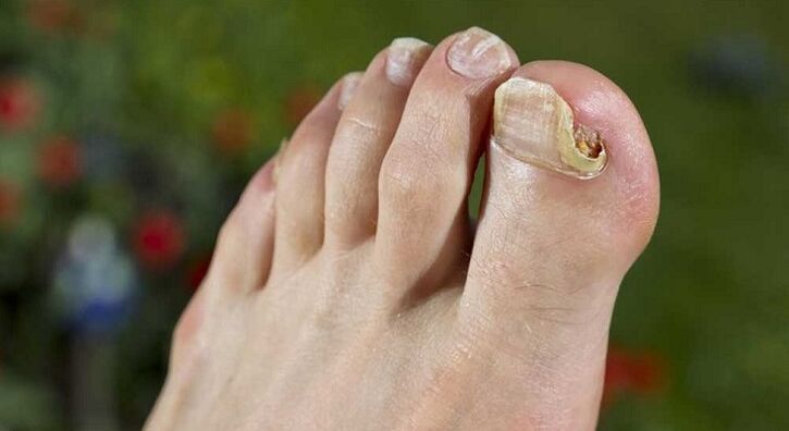 поражение ногтевой пластины при грибке на ногах