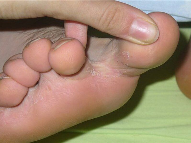 грибок между пальцами ног фото 1