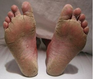 грибок на ногах как выглядит