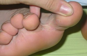 Грибок между пальцев ног